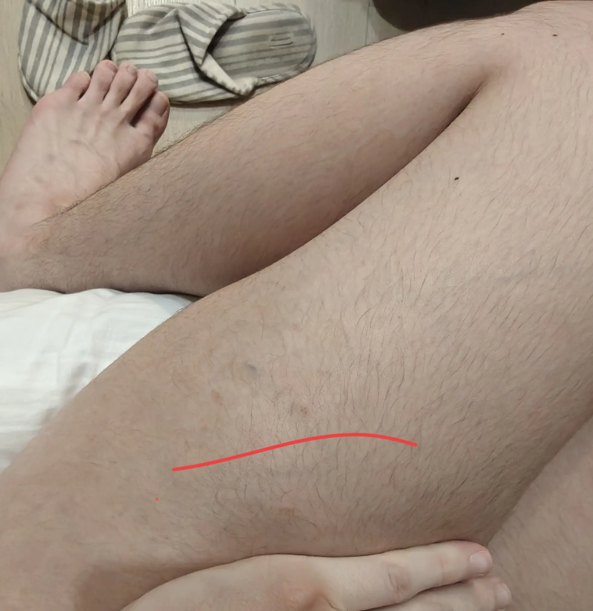 my left leg, with two sets of two red dot marks, evenly separated